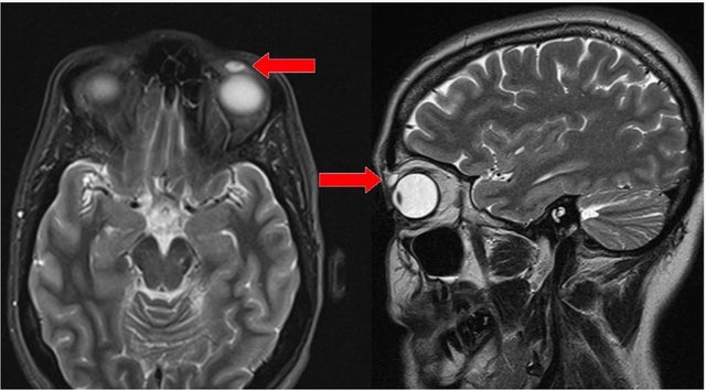 missing-contact-lens-bmj-case-reports.jpg