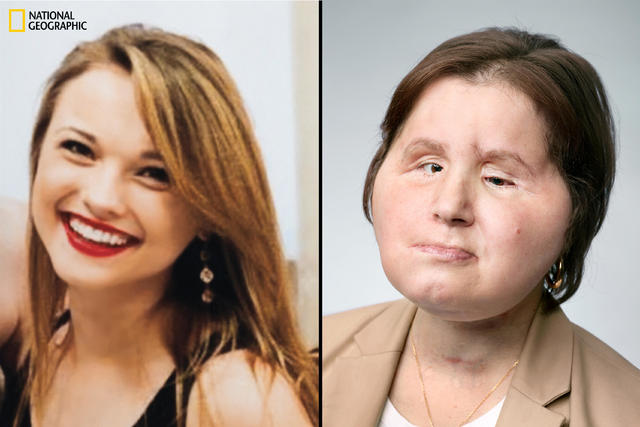Frenchwoman who had face transplant ready for normal life