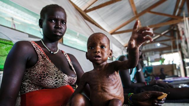 SSUDAN-UNREST-MALNUTRITION 