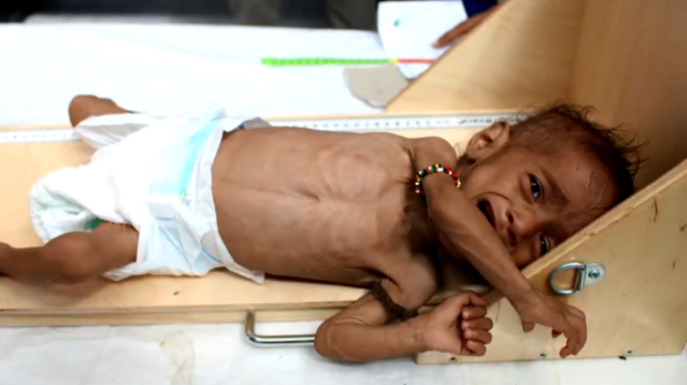 181120-yemen-civil-war-children-malnutrition-04.png 