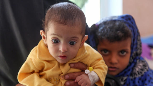 A Yemeni child suffering from malnutrition is seen being held by a woman at a treatment center in a hospital in Taiz on Nov. 21, 2018. 