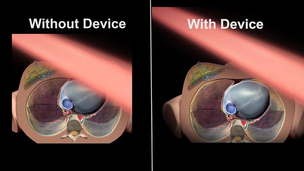breast cancer device 