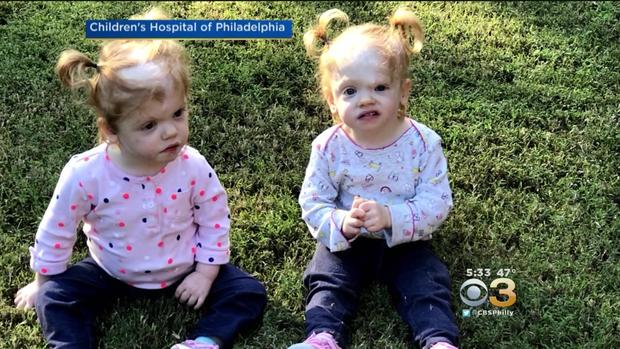 CHOP Getting More Recognition For Historic Surgery To Separate Conjoined Twins 