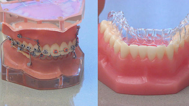 braces or aligners 