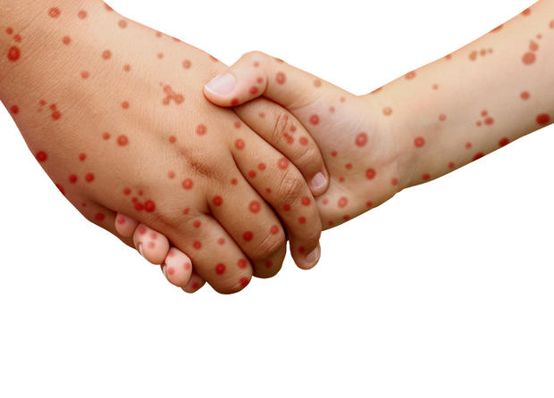 Measles Disease 
