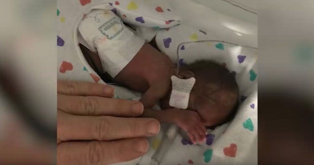 Premature Baby Weighing 13.7 Ounces Celebrates 1st Birthday In Atlantic City 