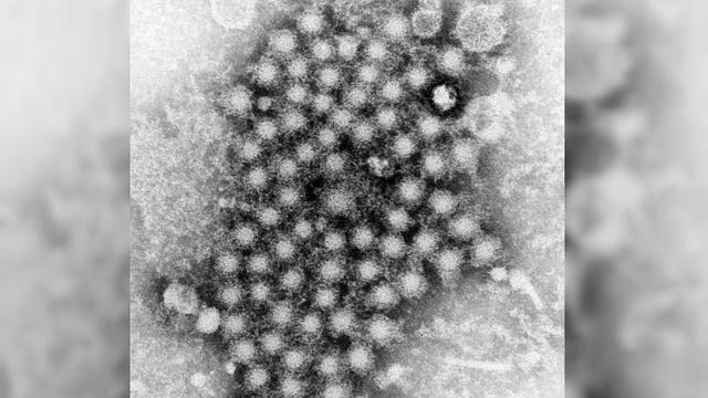 hepatitis-a.jpg 