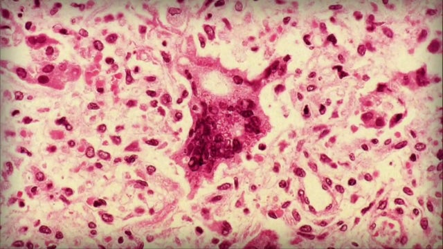 measles.jpg 