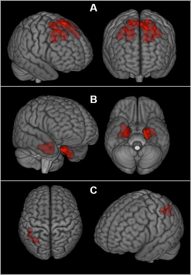 Football Concussions Brain Scans 
