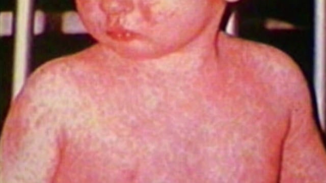 measles.jpg 
