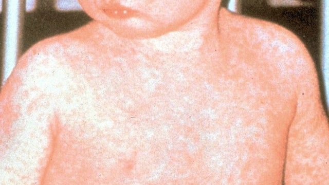 measles.jpg 