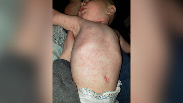 baby-measles-sara-blum.jpg 