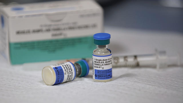 Measles Makes Comeback, As Outbreak Happens In 22 States 