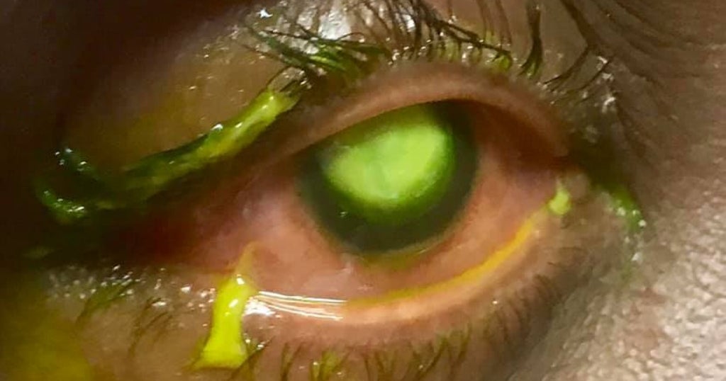 Eye Doctor Shares Graphic Images To Warn Against Sleeping In Contact