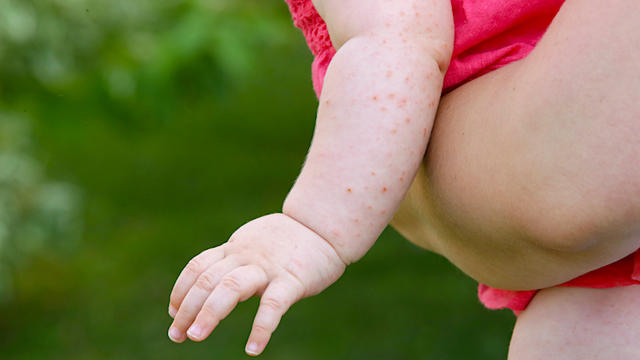 measles-1007140978.jpg 