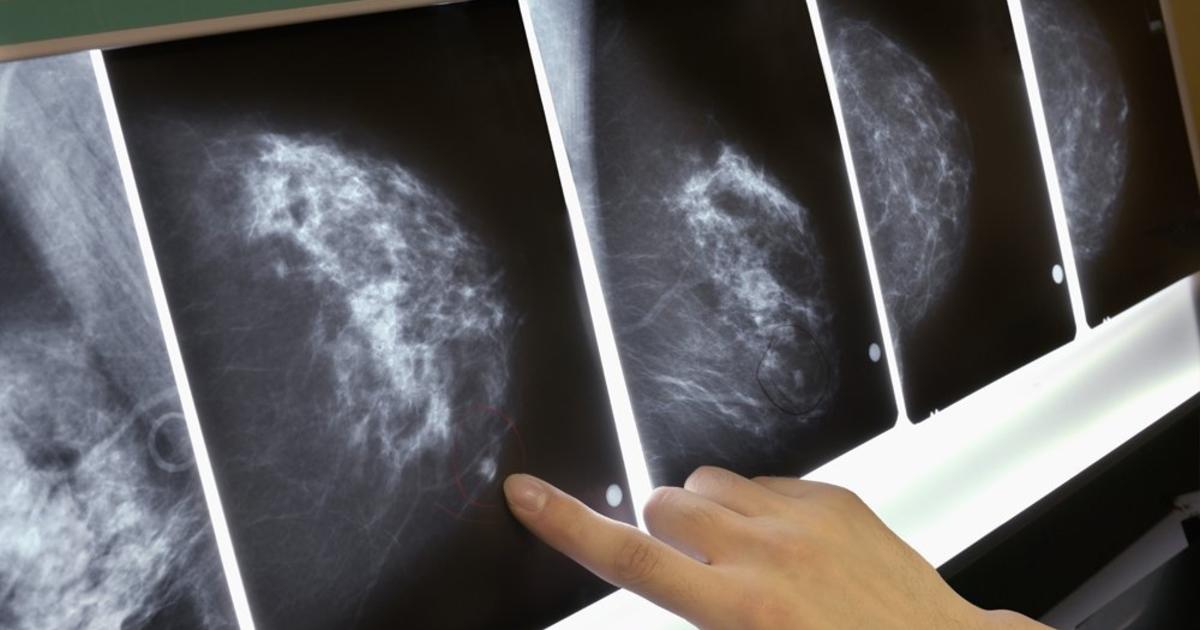 Drug Extends Life Of Younger Women With Advanced Breast Cancer, Study Says - CBS Sacramento