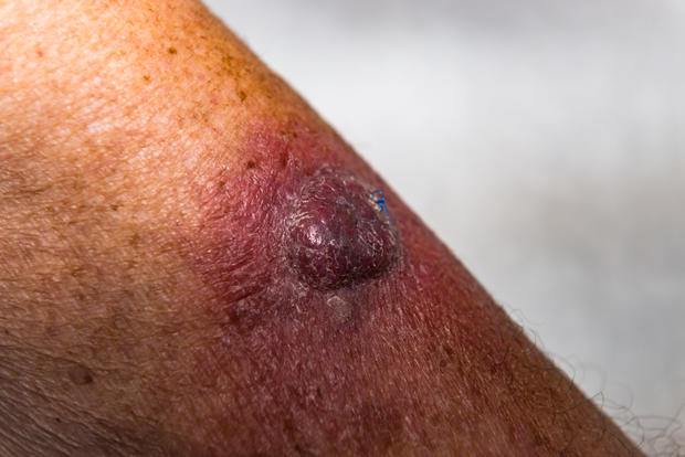 Invasive Squamous Cell Carcinoma on Left Arm 