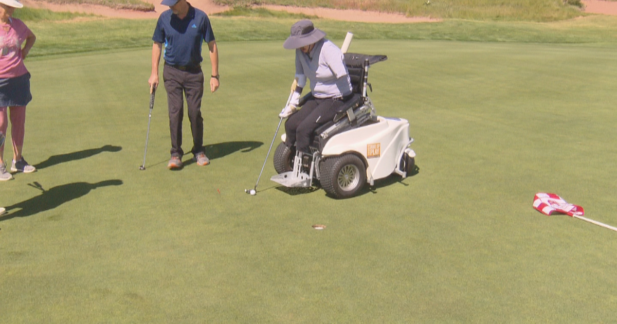 Burn Survivor Golfs To Raise Money For Other Survivors CBS Colorado