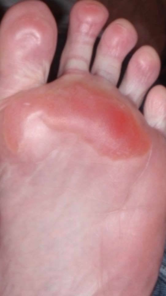BOUNCE HOUSE BURN FOOT 