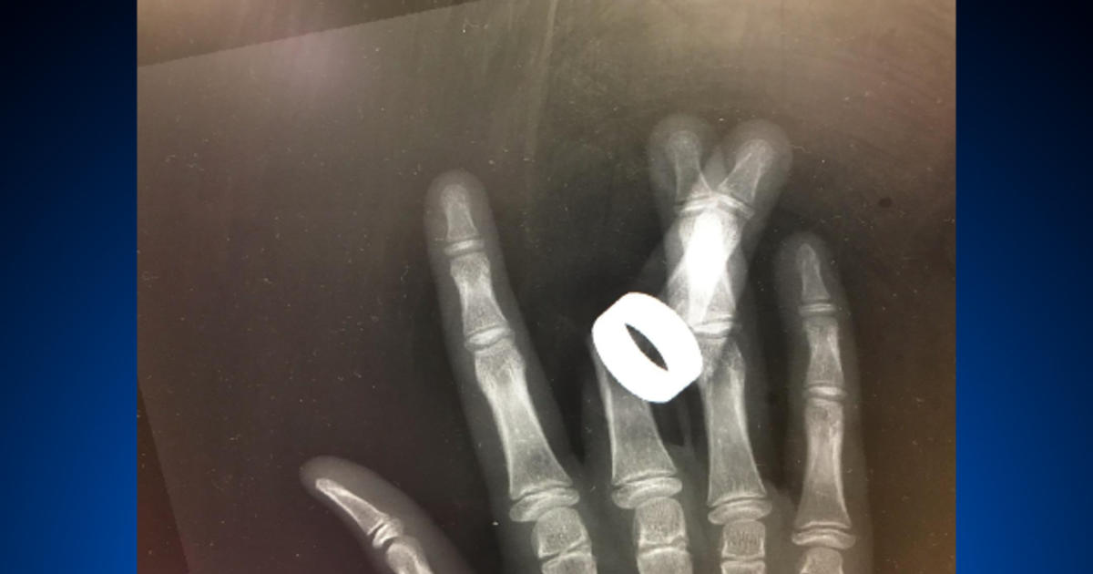 A Novel Approach in Management of Ring Avulsion Injuries Not Amenable to  Replantation