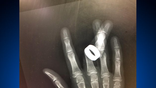ring-avulsion-x-ray.jpg 