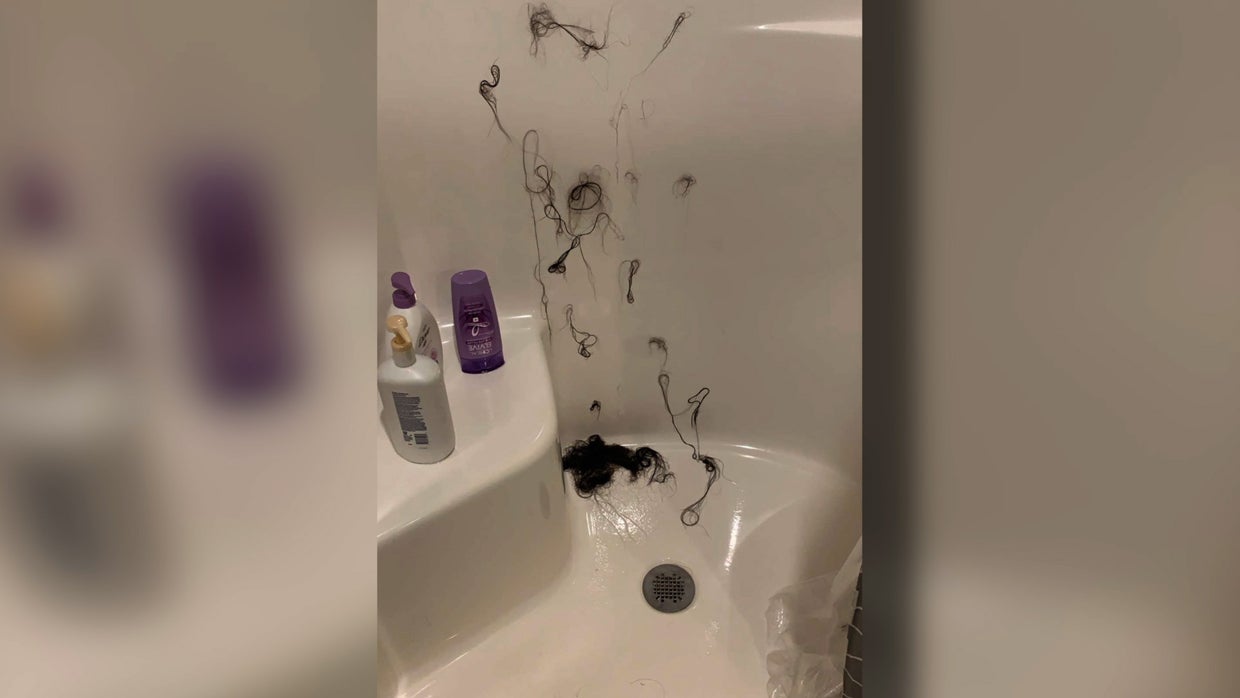Hair Loss 