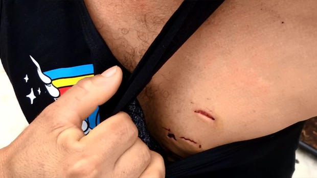Scars on chest shark victim 