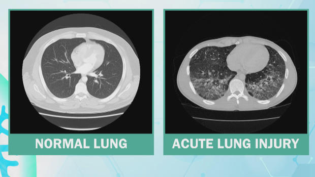 lung-injury-620.jpg 