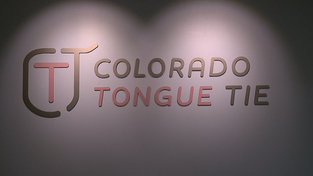 TONGUE TIE 6PKG.transfer_frame_836 