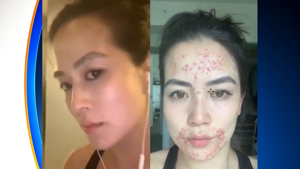 CBS4's Frances Wang Brings Awareness To Skin Condition In Order To Help
