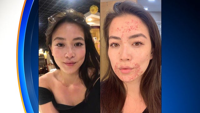 Frances-Wang-Skin-Condition-3.jpg 