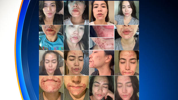 Frances Wang Skin Condition 2 