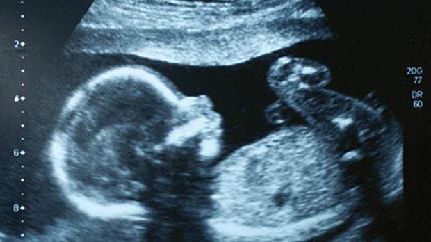 Foetus ultrasound 