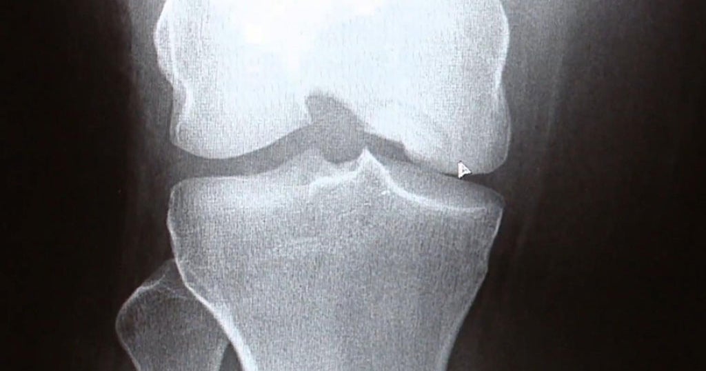 Listening To 'Noisy Knees' Could Help Doctors Predict Arthritis CBS