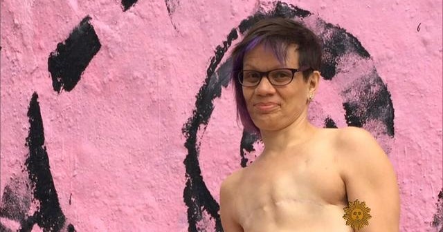 Foregoing reconstructive surgery after breast cancer