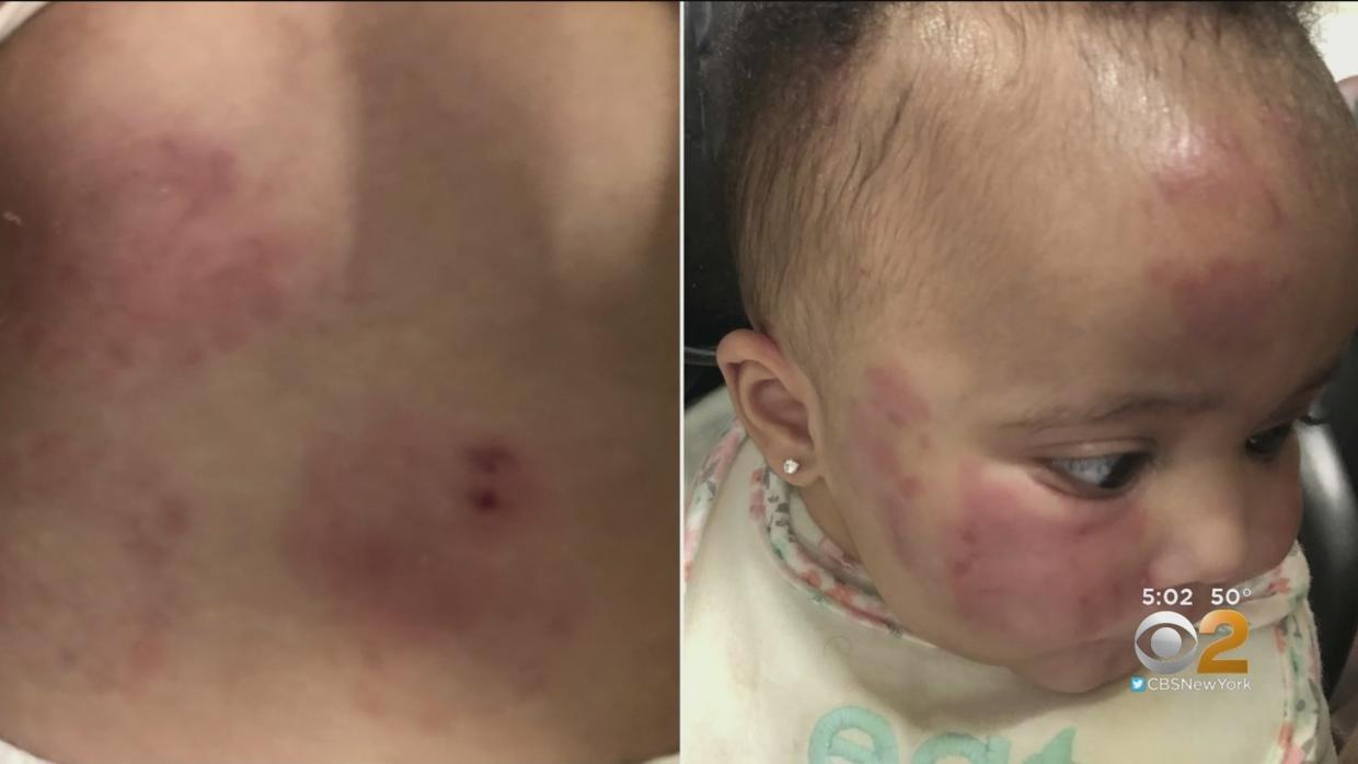 Exclusive: 6-Month-Old Infant Left Covered In Bruises At Unlicensed New ...