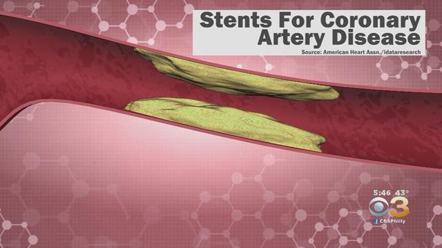 heart-stent.jpg 