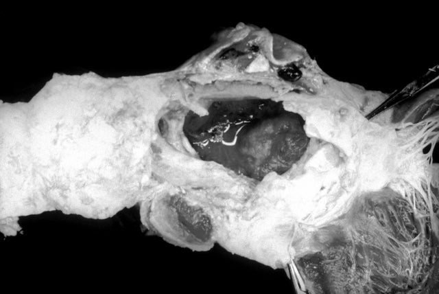 Ruptured Aortic Aneurysm 