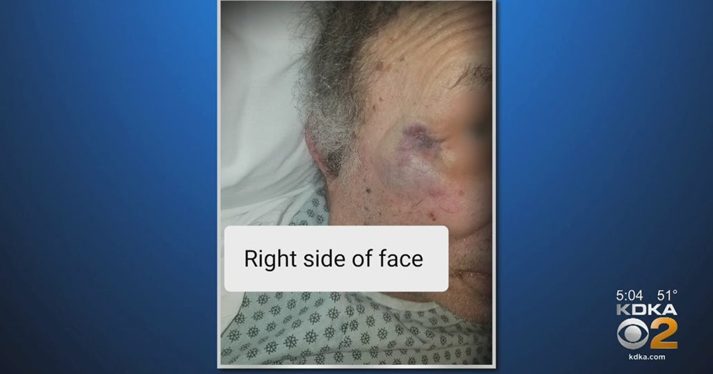 Woman Says 82YearOld Father With Dementia Was Assaulted By Employee At McKeesport Nursing Home