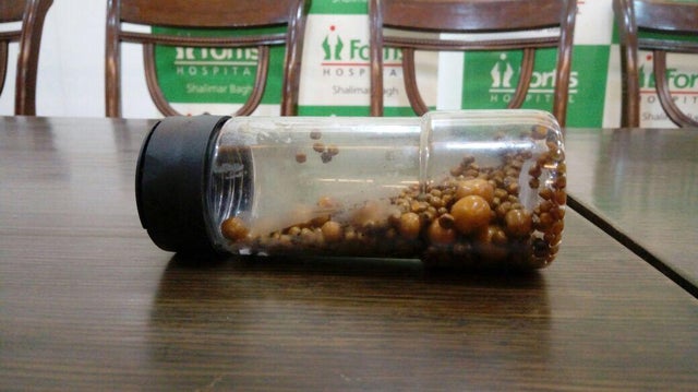 838 Stones Removed From A Patient's Gallbladder In New Delhi Hospital 