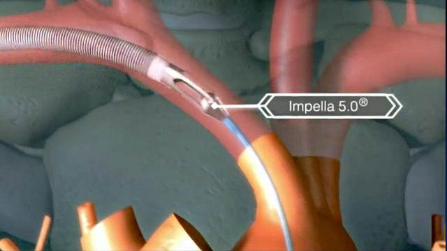 heartpump-impella.jpg 