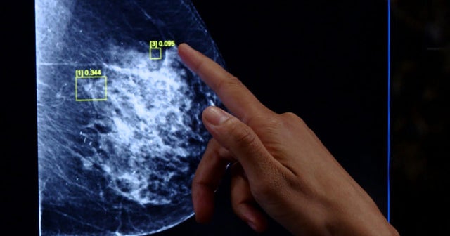 Artificial intelligence aims to improve breast cancer diagnoses CBS News