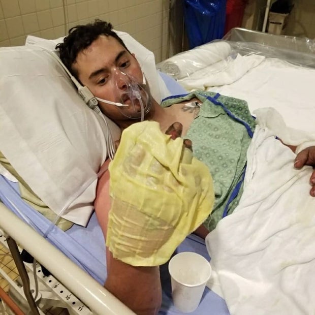 Burned Firefighter 1 (from Platte Canyon Fire Prot District FB)