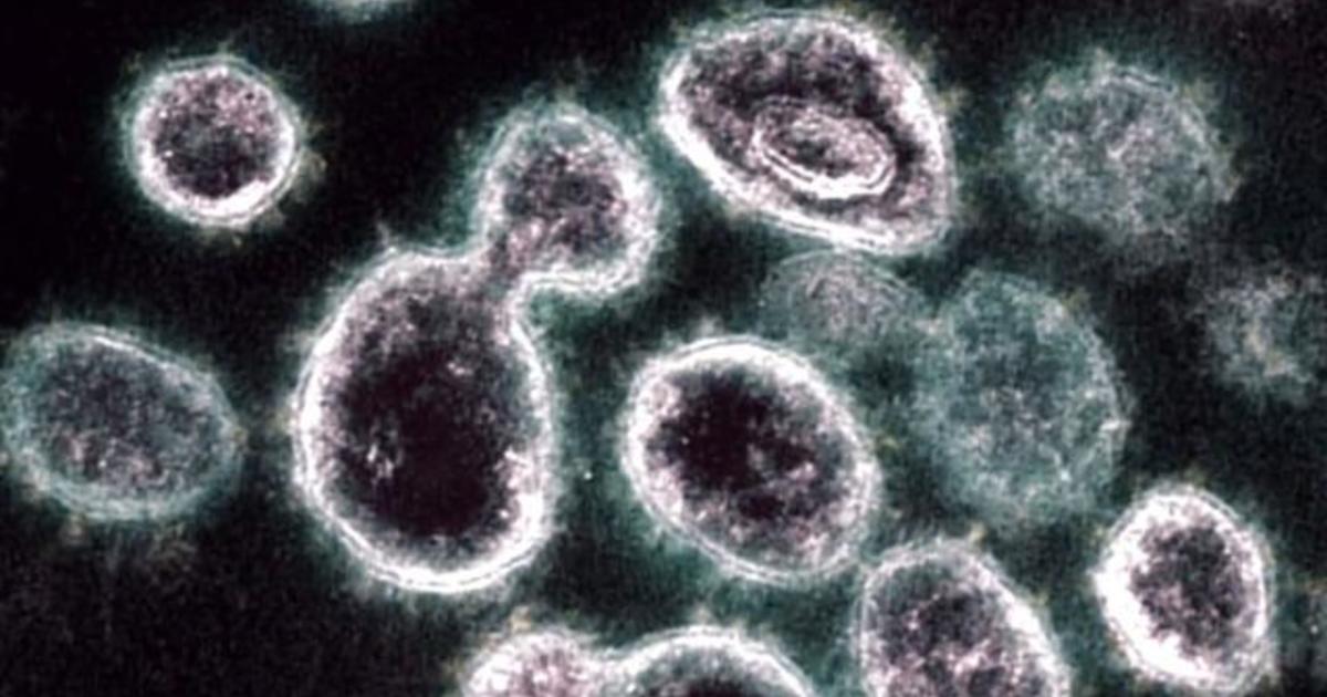 Coronavirus causes hundreds of deadly blood clots in the lungs