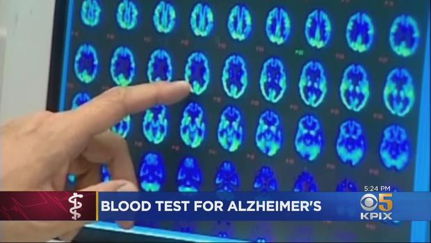 alzheimers blood test 