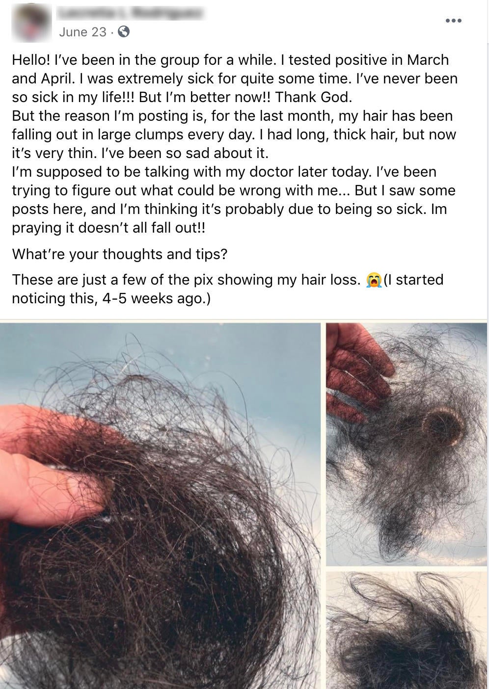 Does Covid Make Your Hair Fall Out