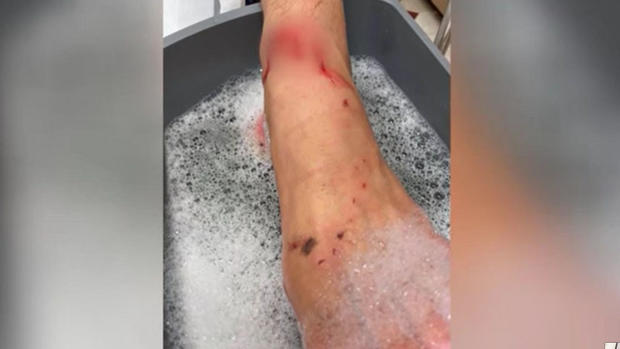 Florida Teen Shark Bite Wound 