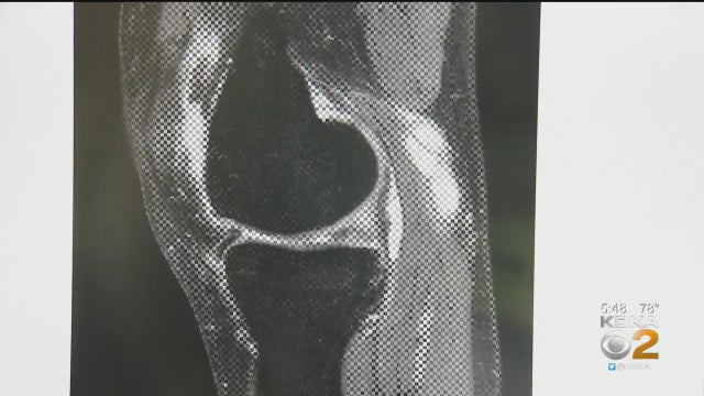Osteoarthritis.jpg 