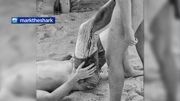 Miami Beach Shark Attack 