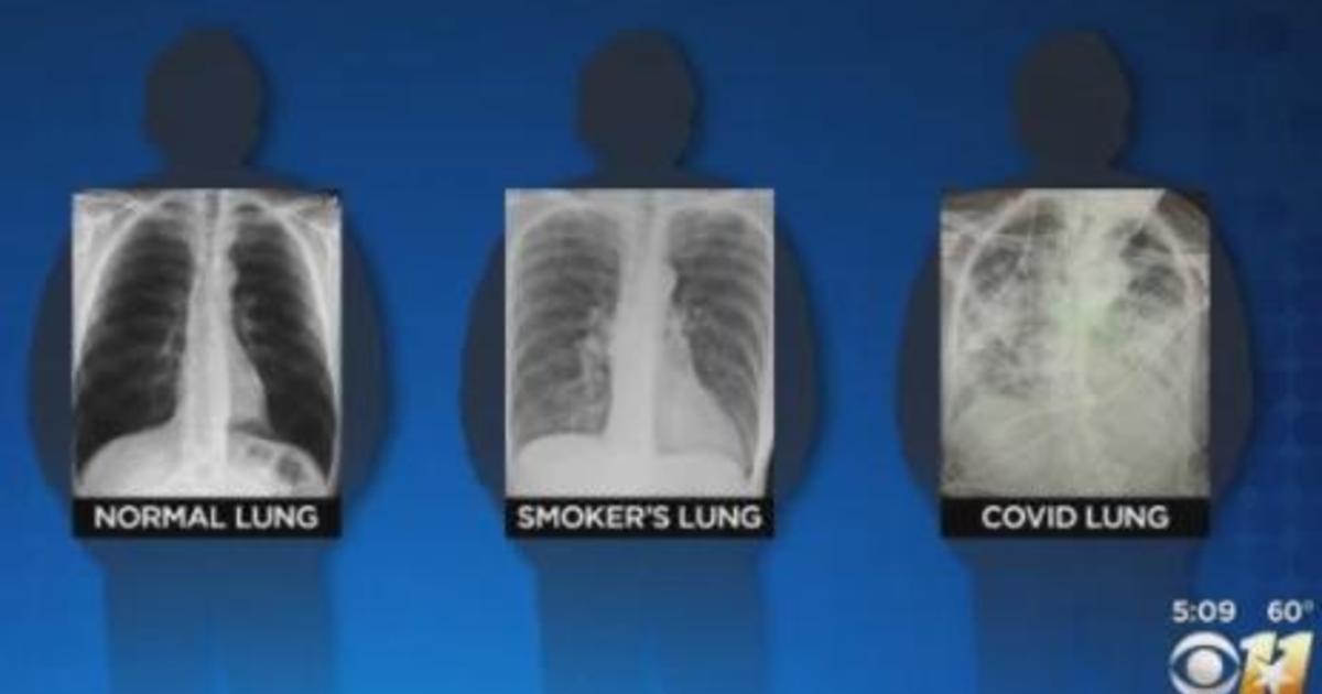 Post-COVID lungs worse than the worst smokers' lungs, surgeon says ...